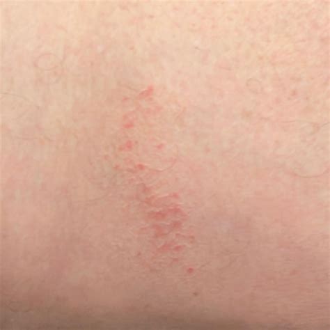 linear lichen  consultation ai dermatologist