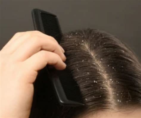 how to remove dandruff without washing hair