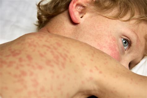 America’s Measles Outbreak: What You Need to Know | Rutgers Health