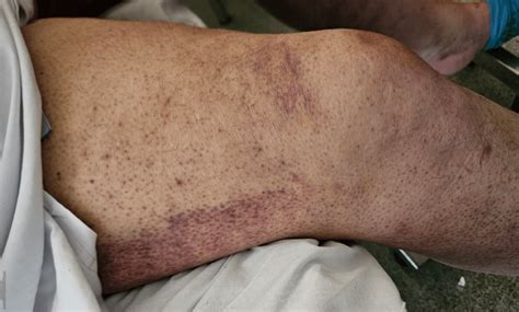 scurvy   comeback   predicted    common