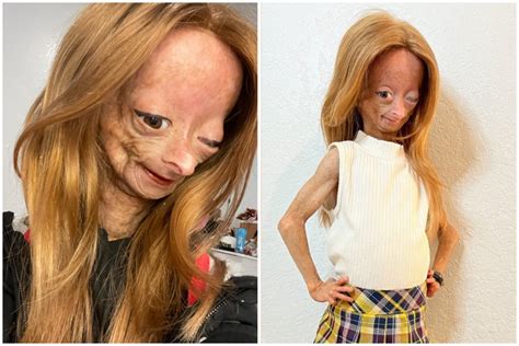 Adalia Rose Tributes Pour In After YouTuber With Rare Aging Disorder