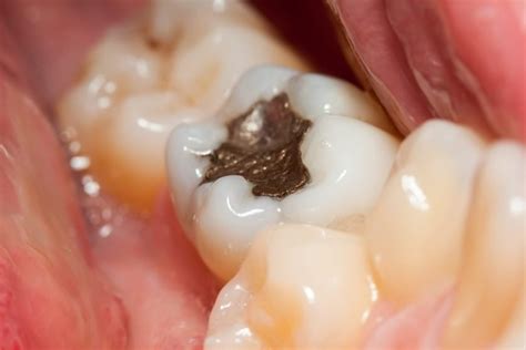 how long does it take to do a tooth filling