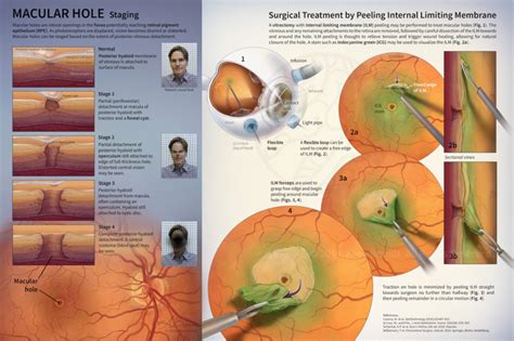 Macular Hole: Staging and Surgical Treatment – Alisa Brandt's Portfolio