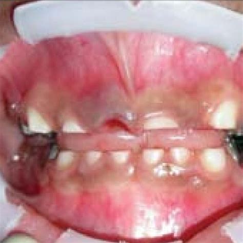 Preoperative photograph showing severe attrition of maxillary teeth ...