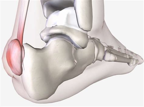 Haglund's deformity: Causes, symptoms, and treatment
