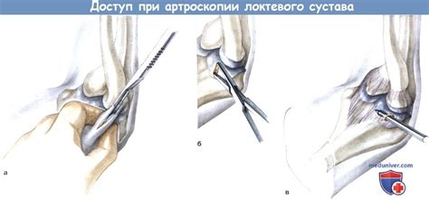 Техника артроскопического доступа к локтевому суставу