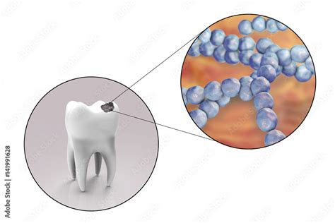 Streptococcus Mutans