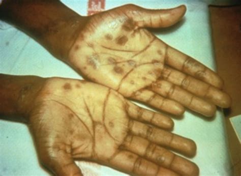 Syphilis — Types, Diagnosis and Treatment | Online Medical Library