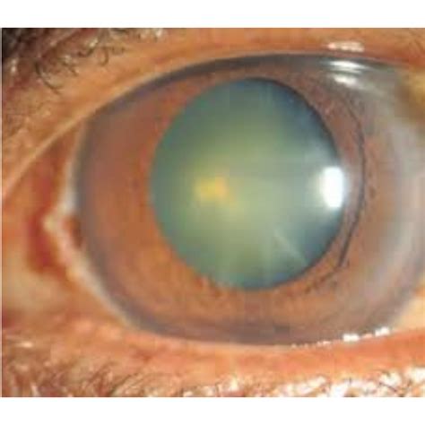 clearing  fog understanding cataracts symptoms  treatment options