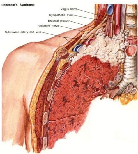 Pancoast Tumor - Physiopedia