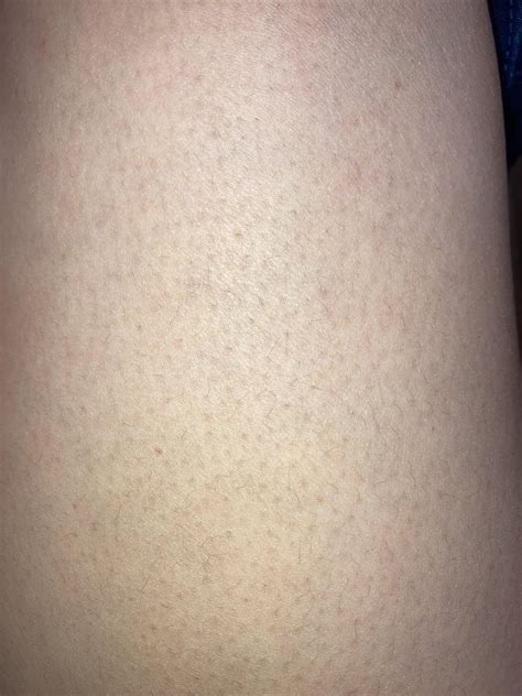 Thigh acne : r/Skincare_Addiction