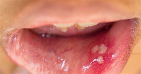 HPV in the mouth: Symptoms, causes, and treatment