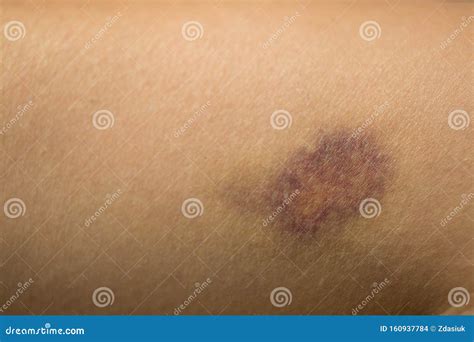 Bruise On The Leg Of A Woman. A Bruised Leg. Close-up Royalty-Free ...