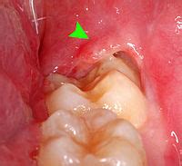 pericoronitis wikipedia