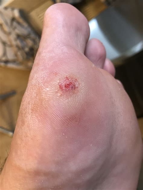 Pulling Out Plantar Wart Root | Renew Physical Therapy