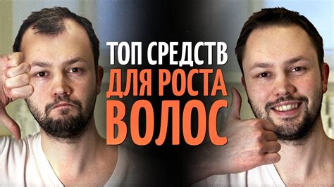 ТОП 5 средств для роста волос от врача дерматолога - YouTube