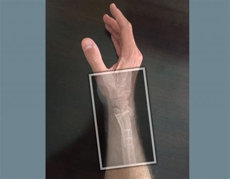 Distal radius fracture splint type - nerymotorcycle