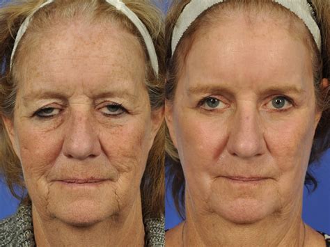 laser skin resurfacing    page   cosmetic surgery