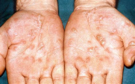 Secondary Syphilis Rash - Stock Image - C036/5839 - Science Photo Library