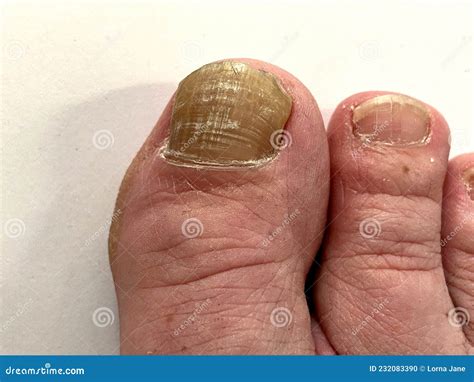 Toenail Nail Fungus - Big Toe of a Person Suffering from Onychomycosis ...