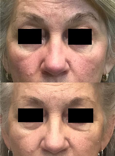 Rosacea Laser Treatment Bruising