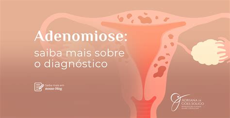 Adenomiose Afeta O Intestino - Adenomiose: saiba mais sobre o diagnóstico - Adriana de Goes