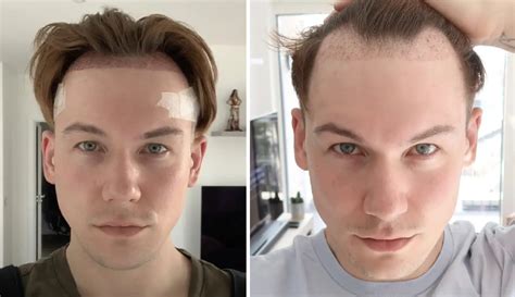 hair transplant   month  results side effects