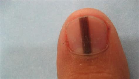 O Que Significa Uma Linha Preta Na Unha Do Dedão - O que significa uma linha preta na unha? – Fatos Desconhecidos