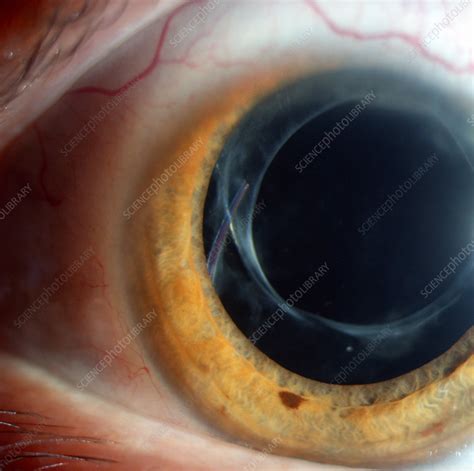 Intraocular Lens Implant - Stock Image - C027/2227 - Science Photo Library