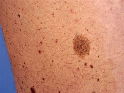 Acquired Melanocytic Nevus