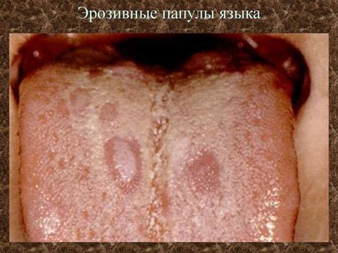 Вторичный период сифилиса - презентация онлайн
