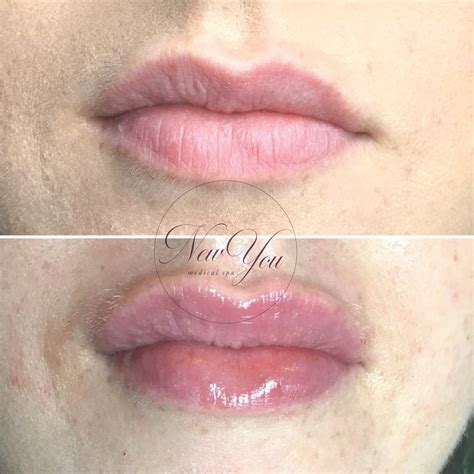 Pin by NewYouMedicalSpa-Botox+Fillers on Lips filler injections