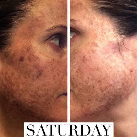 BBL & CoolPeel Before & After, Case 2 | Female, age 45 – 54 | Pura Vida ...