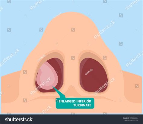 Nasal Turbinate Hypertrophy