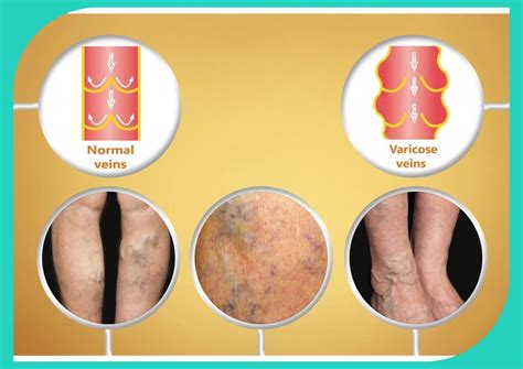 varicose veins  seniors  care  smart solutions