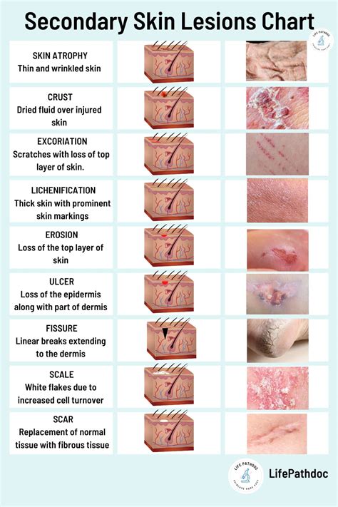 What Is A Lesion Medical at Betty Peak blog