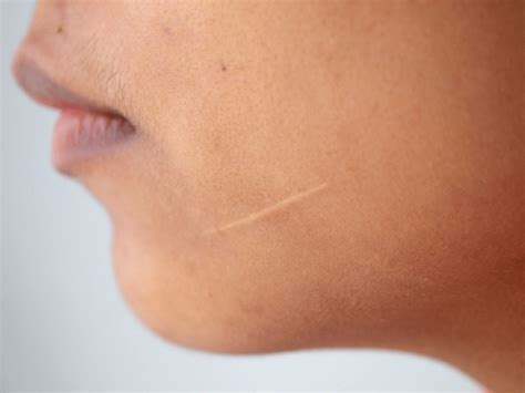 Discover Effective Treatments for Facial Scars: Transform Your Skin Today - Hunter Games Magazine