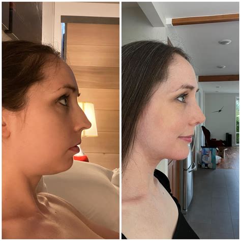 1 month post op. Chin implant, neck lift and nose job with Dr Yirae Ort