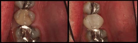 Patient Testimonial: Bernie’s CEREC Crown – Atlanta Cosmetic Dentistry ...