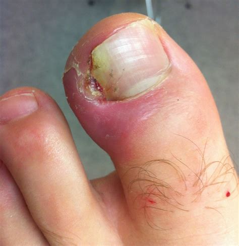 Ingrown Toenail Treatment