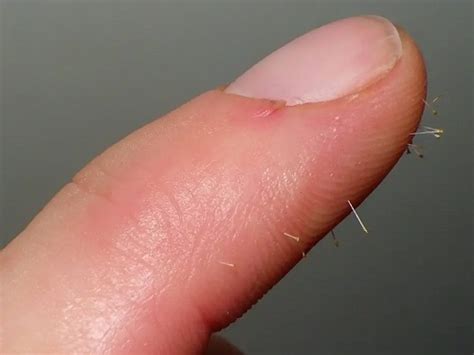 how long does it take for cactus needles to dissolve