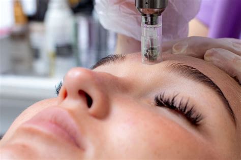 winter recovery tips  microneedling