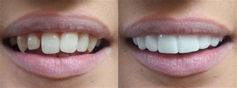veneers whats   beautiful smile hutto hippo