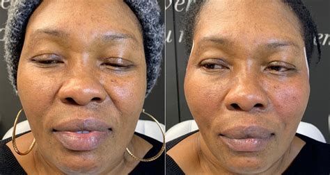 thread lift procedure skin outcomes pics cost