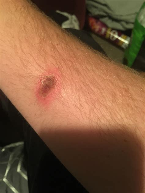 What Does A Spider Bite Look Like From A Brown Recluse at Kevin