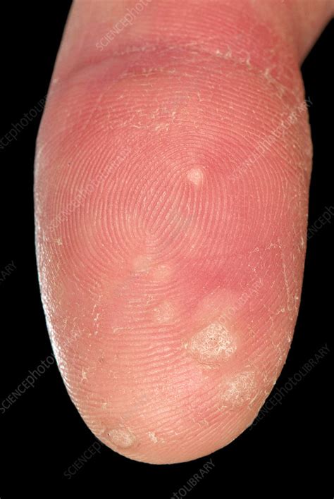 common warts stock image  science photo library