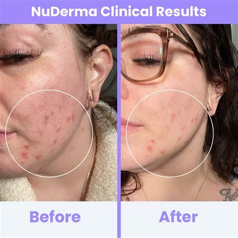 NuDerma Clinical High Frequency Wand – Pure Daily Care