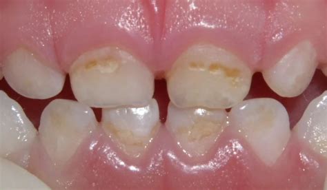 faq  babies  cavities discovery pediatric dentistry