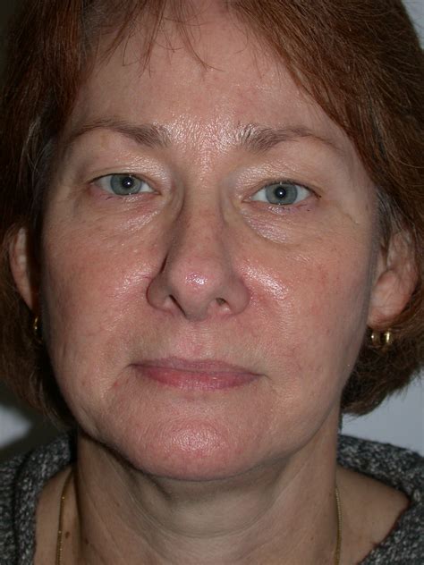 Thermage Before & After Photos | Adoro Medical Spa