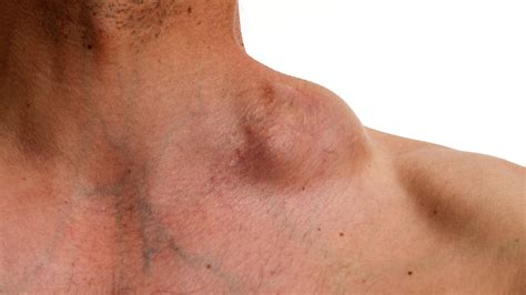 O Que É Câncer Linfático - Cáncer linfático: Conoce los tipos, síntomas y tratamientos